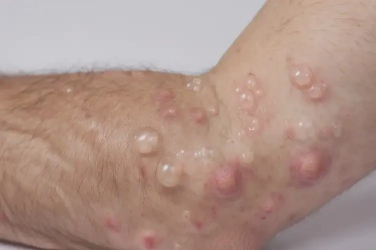 男生身上长湿疹能彻底自愈吗(图4)