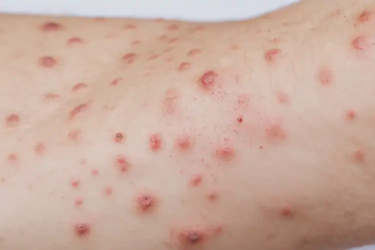 男生手臂經(jīng)常長濕疹能靠自己自愈嗎(圖4)