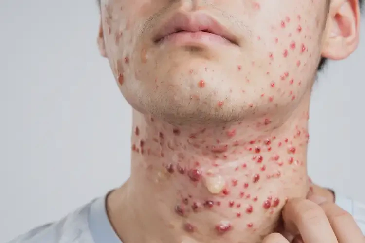 男生脖子偶爾長濕疹能靠自己自愈嗎(圖3)