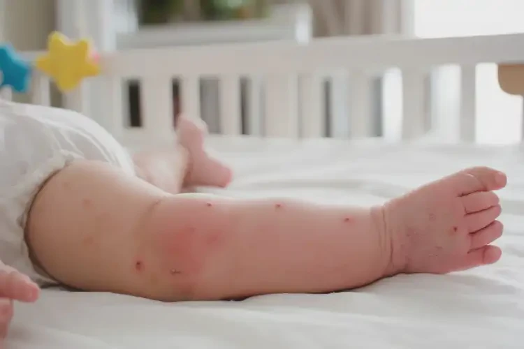 寶寶四肢偶爾長(zhǎng)濕疹可以徹底自愈嗎(圖3)