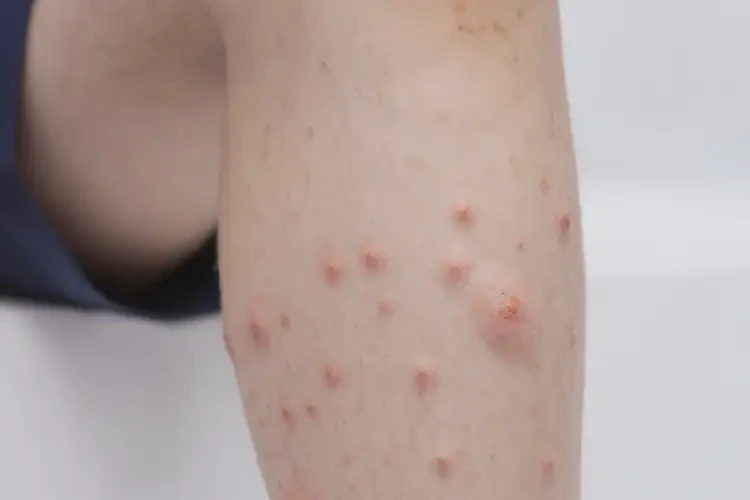 小學(xué)生小腿上容易起濕疹不管它會(huì)自己自愈嗎(圖4)