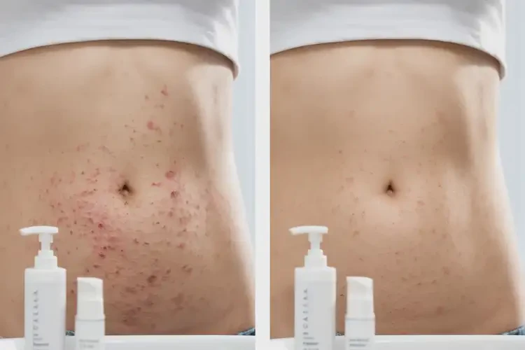 中學生肚子上偶爾長濕疹可不可以徹底自愈(圖2)