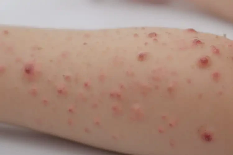 少兒手臂上有濕疹可以徹底自愈嗎(圖4)