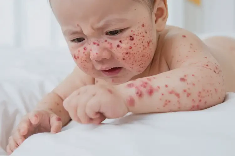 嬰幼兒全身容易長(zhǎng)濕疹可不可以徹底自愈(圖4)