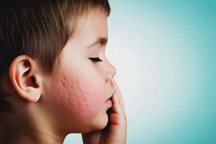 孩子全身起濕疹不管它會自己痊愈嗎(圖2)