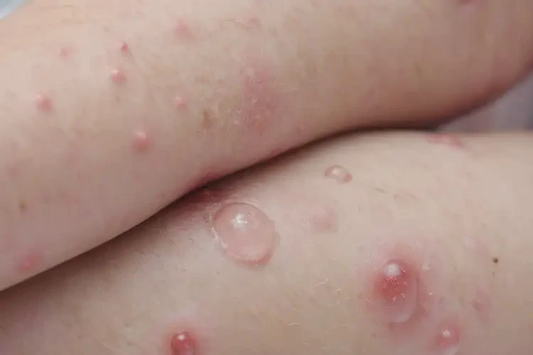 孩子四肢出現(xiàn)濕疹可以徹底自愈嗎(圖4)