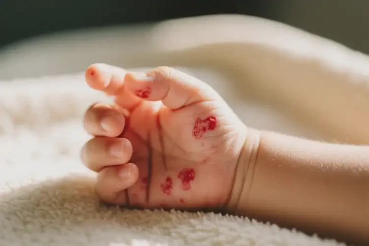 幼兒手上有濕疹不管它會(huì)自己痊愈嗎(圖4)