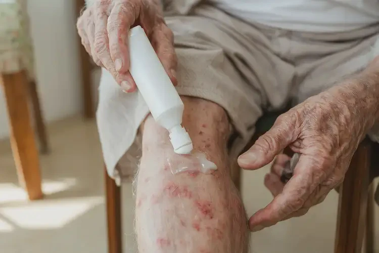 老年人小腿上經(jīng)常長濕疹能徹底自愈嗎(圖3)