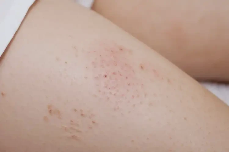 產(chǎn)婦大腿出現(xiàn)濕疹可以徹底自愈嗎(圖4)