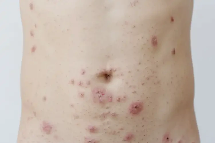 青少年肚子上有濕疹不管它會自己好嗎(圖4)