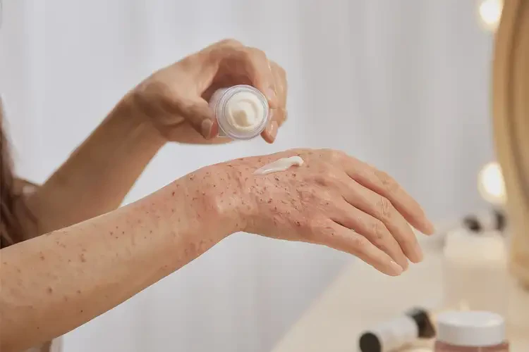 女人手上出現(xiàn)濕疹可以徹底自愈嗎(圖3)