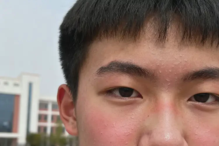 大學(xué)生面部容易起濕疹可以徹底自愈嗎(圖3)