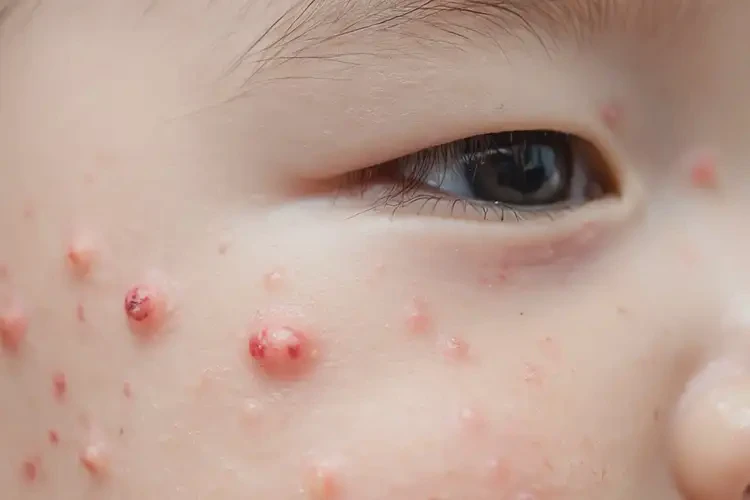 嬰幼兒屁股長(zhǎng)濕疹能夠徹底治愈嗎(圖4)