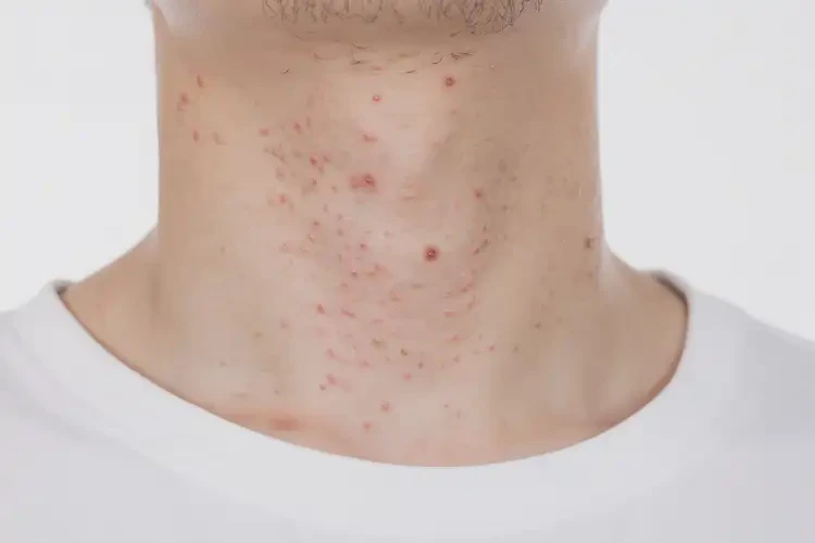 青年人脖子上出濕疹不管它會(huì)自己好嗎(圖4)