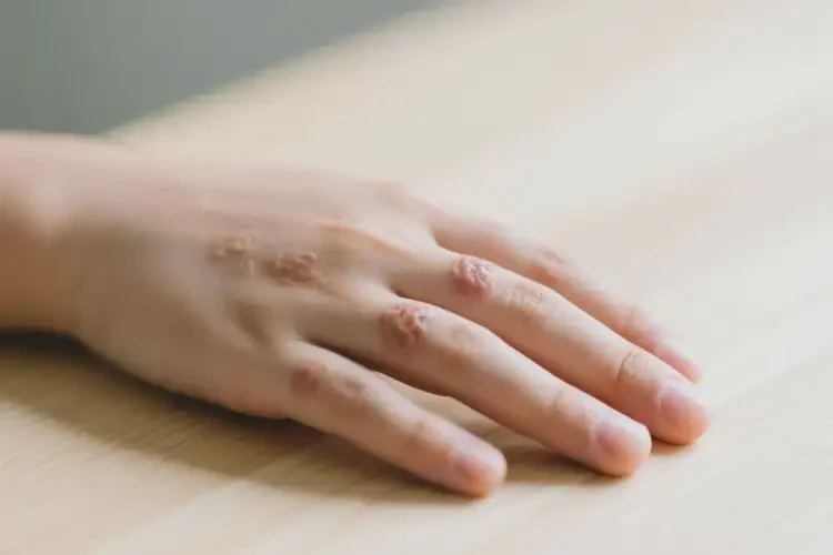 青年人手上偶尔起湿疹不管它会自己好吗(图4)