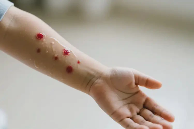 孩子手臂上出現(xiàn)濕疹不管它會自己好嗎(圖1)