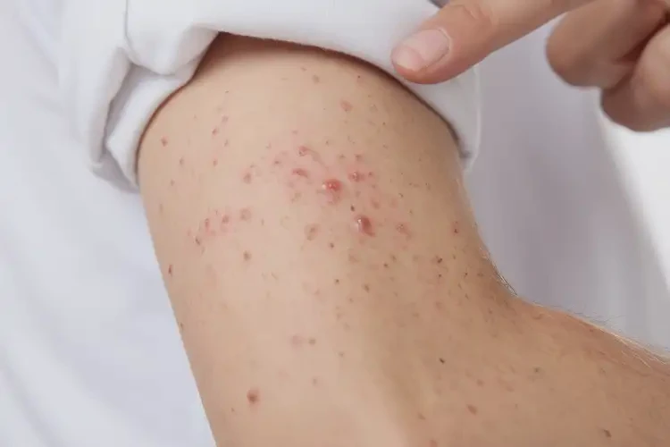 青少年手臂上偶爾長(zhǎng)濕疹不管它會(huì)自己自愈嗎(圖4)