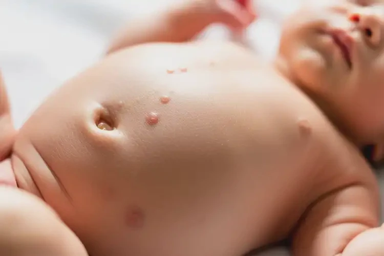 新生兒肚子上出濕疹能徹底自愈嗎(圖1)