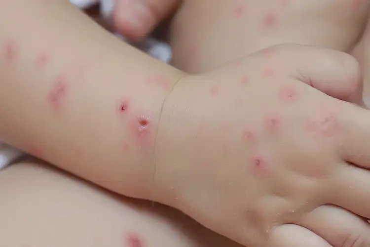 小孩四肢经常长湿疹可以彻底自愈吗(图4)