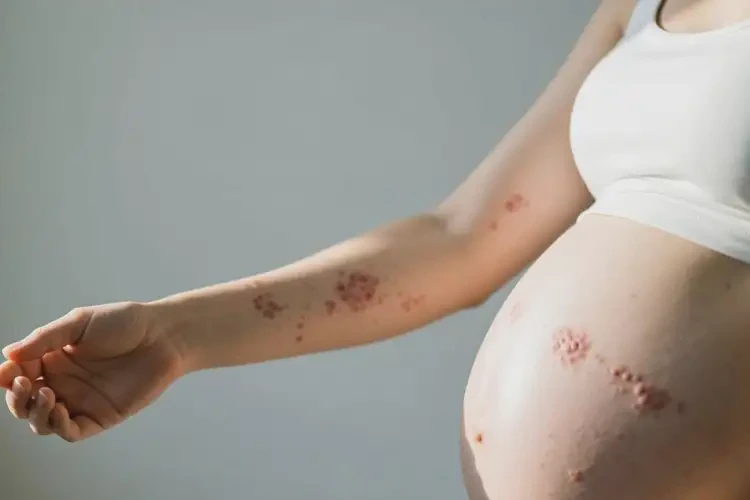 產(chǎn)婦手臂上經(jīng)常起濕疹能靠自己自愈嗎(圖2)