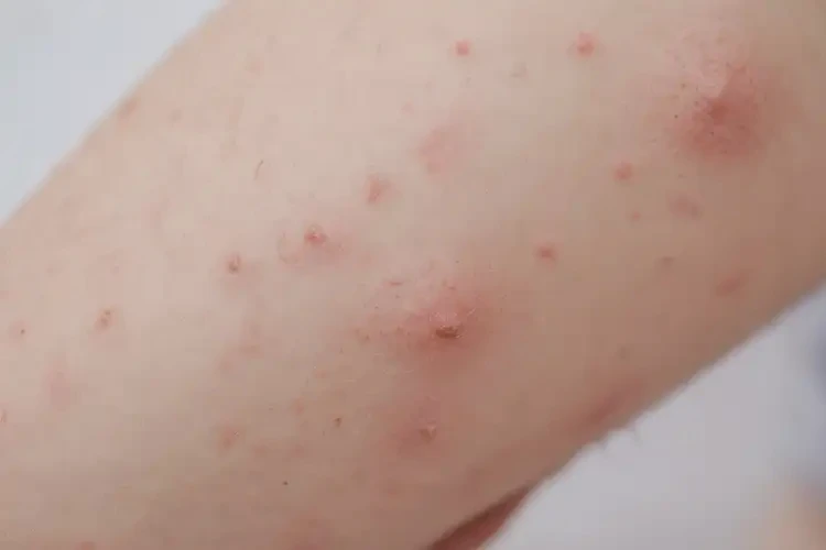 孩子身上偶爾起濕疹可以徹底自愈嗎(圖4)