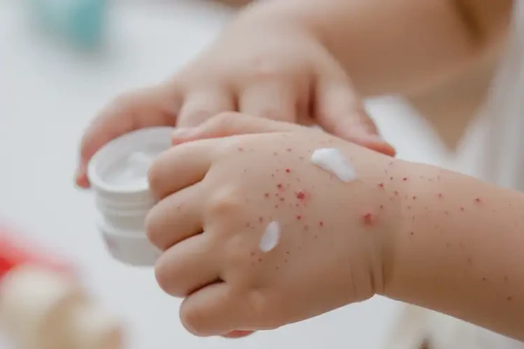 少儿手上有湿疹可以彻底自愈吗(图4)