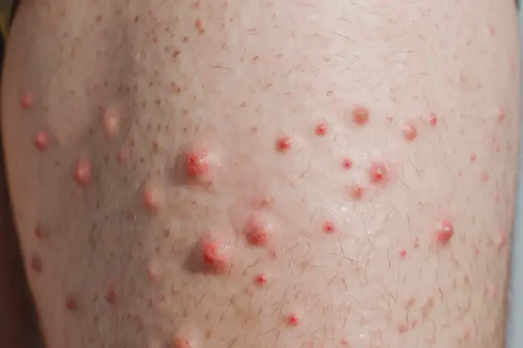 男人大腿上出濕疹能夠徹底治愈嗎(圖4)