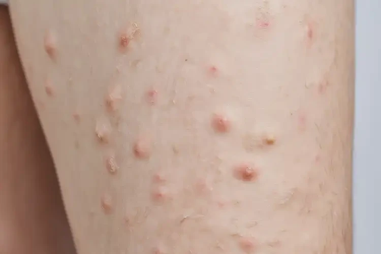 青年人四肢出濕疹可以徹底自愈嗎(圖4)