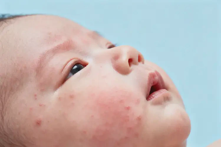 新生兒臉上出濕疹可以徹底自愈嗎(圖3)