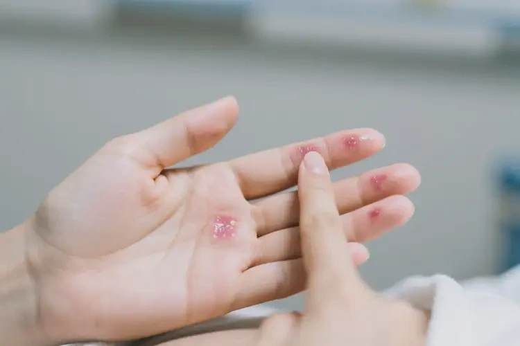 产妇手上偶尔起湿疹能靠自己自愈吗(图3)