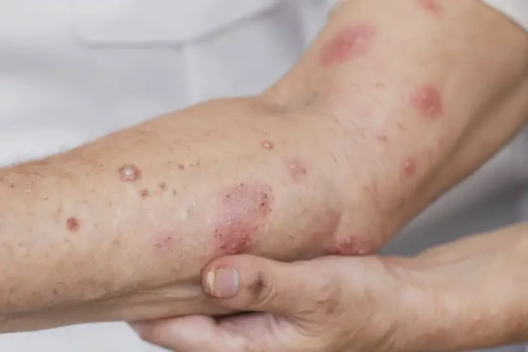 小孩四肢出濕疹不管它會(huì)自己好嗎(圖3)