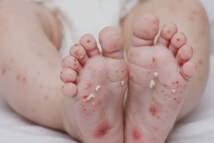 嬰兒腳上經(jīng)常長濕疹能徹底自愈嗎(圖4)