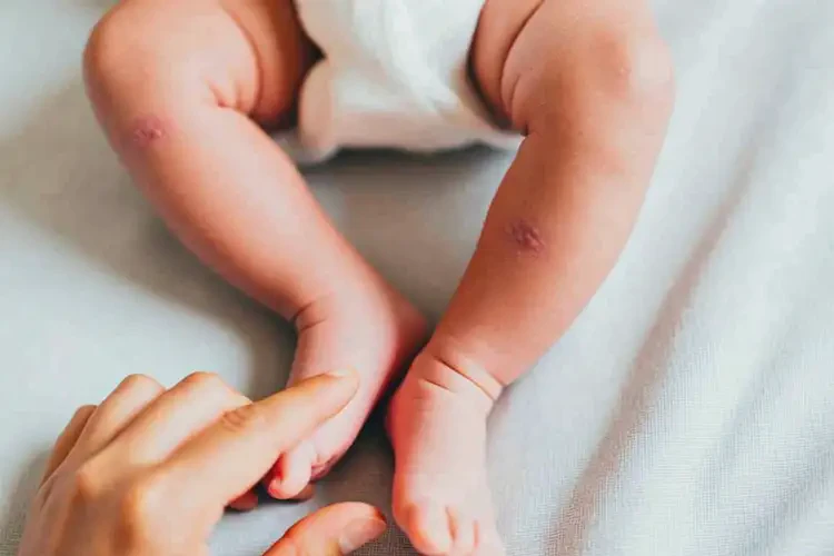 嬰兒小腿上經常長濕疹可不可以徹底自愈(圖3)