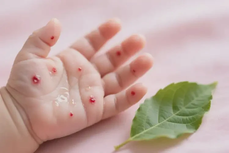 嬰兒手上容易長濕疹能徹底自愈嗎(圖3)