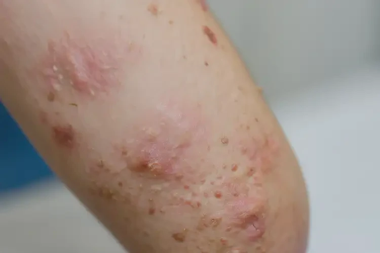 小孩四肢出濕疹不管它會(huì)自己好嗎(圖4)