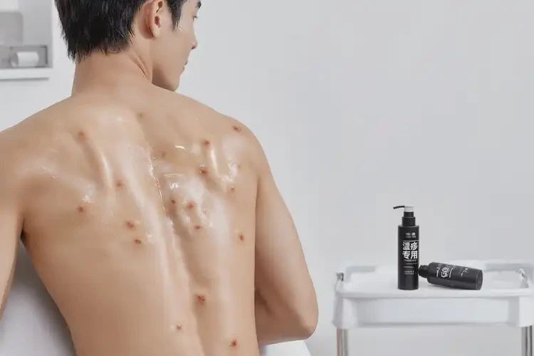 青年人屁股出現(xiàn)濕疹可以徹底自愈嗎(圖3)