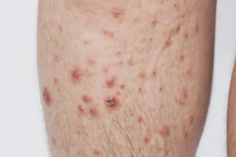 男人小腿長(zhǎng)濕疹可不可以徹底自愈(圖4)