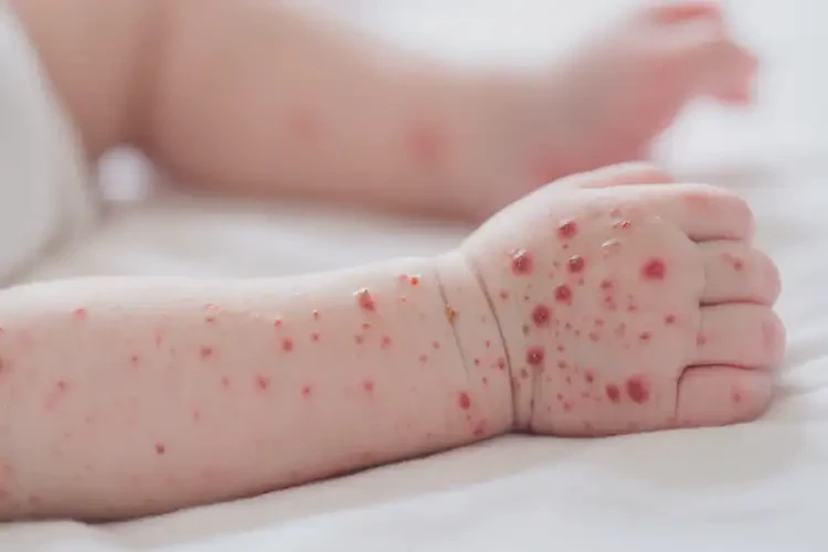 新生兒手臂上出濕疹能徹底自愈嗎(圖4)