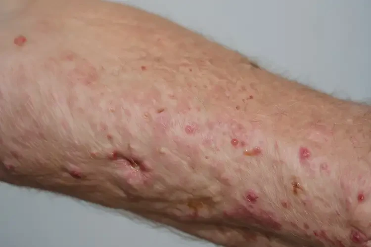 老年人屁股上容易長濕疹不管它會自己痊愈嗎(圖3)