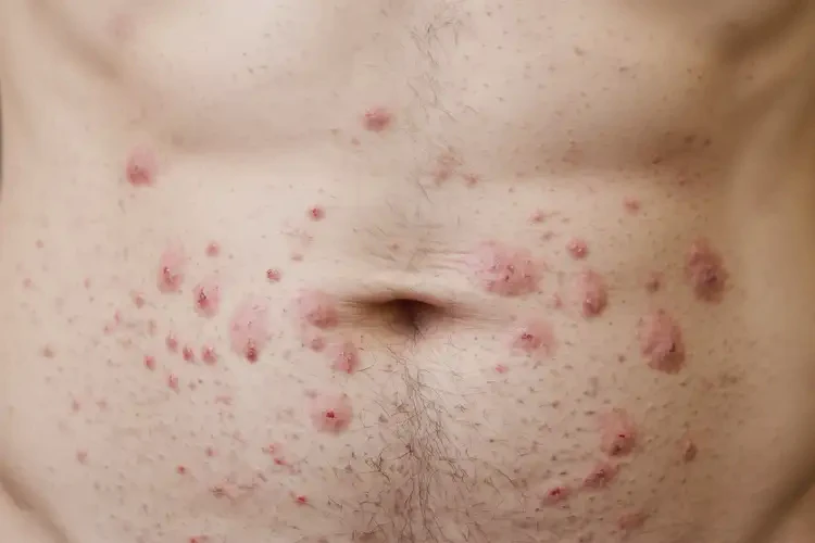 男性肚子有湿疹能彻底自愈吗(图3)