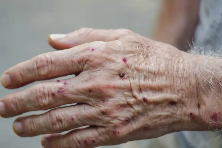 老人手上出現(xiàn)濕疹不管它會自己自愈嗎(圖4)