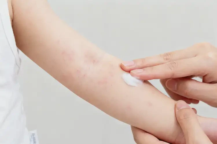 小兒手臂上偶爾起濕疹不管它會(huì)自己自愈嗎(圖2)