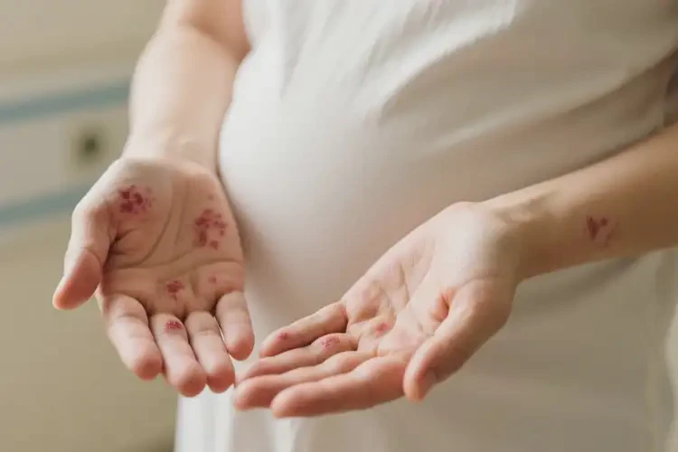 孕婦手上長濕疹不管它會自己自愈嗎(圖4)