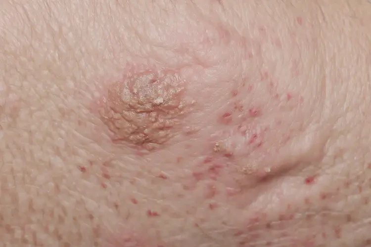 大学生屁股出湿疹不管它会自己自愈吗(图2)