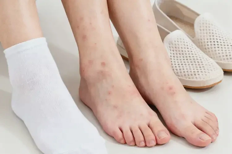 女人腳上容易起濕疹不管它會自己自愈嗎(圖2)