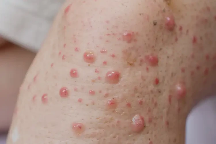 少儿小腿出湿疹可不可以彻底自愈(图4)