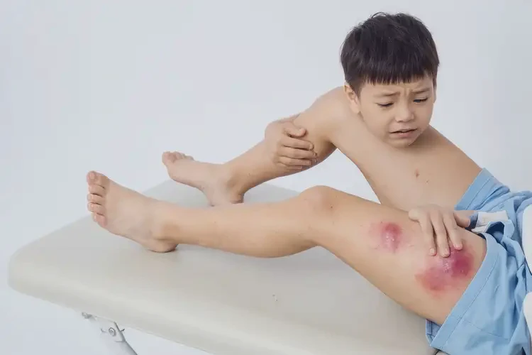 兒童大腿有濕疹能徹底自愈嗎(圖4)