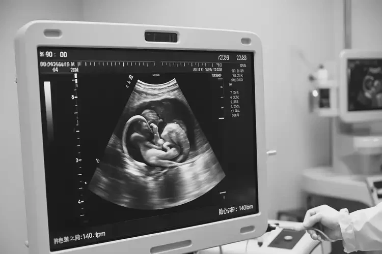 孕20周1天胎心80多還能保住嗎(圖2)