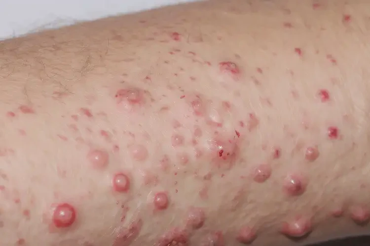 女人身上出濕疹可以徹底自愈嗎(圖4)