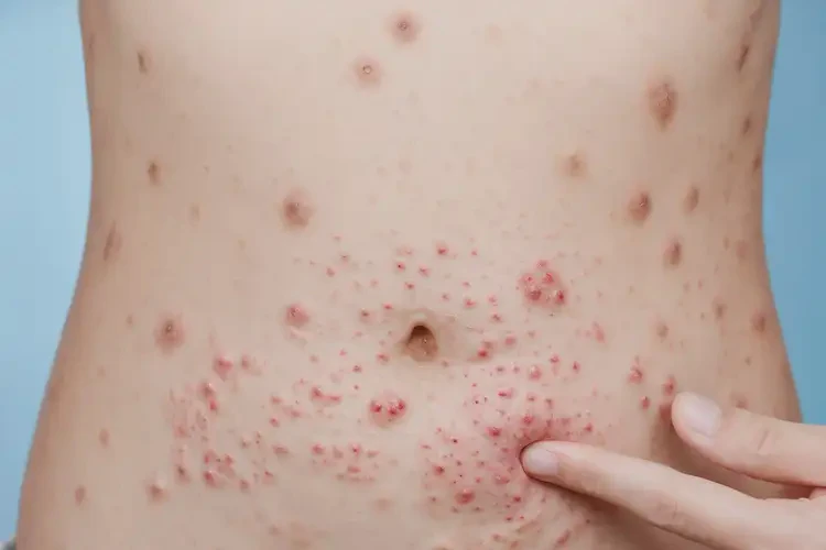 女性肚子上出濕疹可不可以徹底自愈(圖4)
